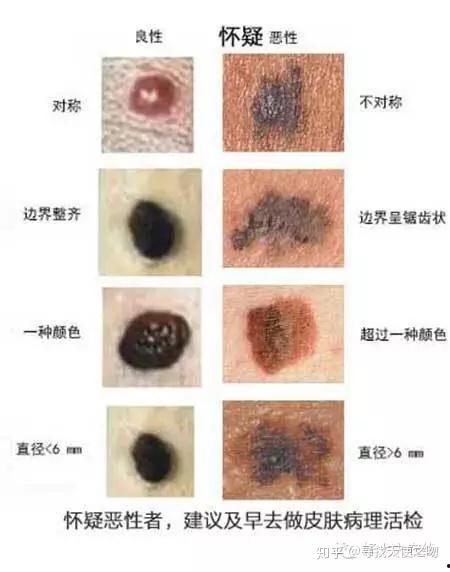 良性黑色素痣图片,图片解析与特征概述