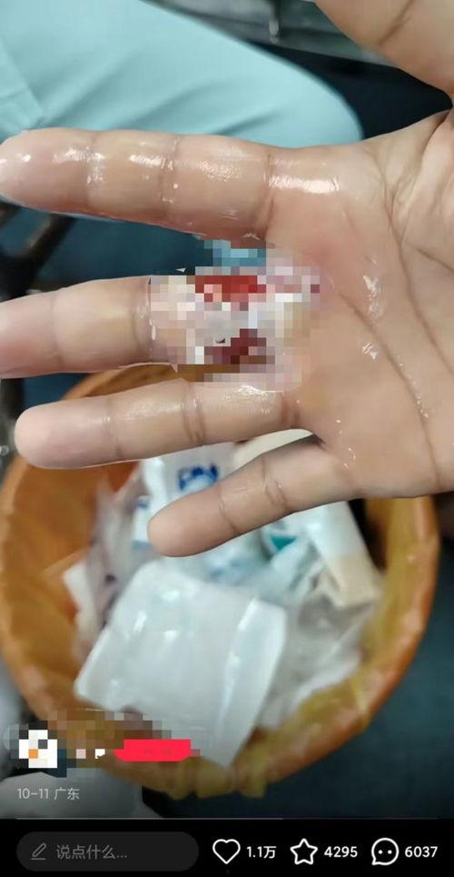 手指受伤图片,揭秘手指受伤的常见原因与护理方法