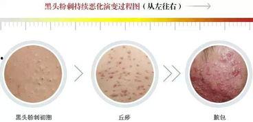 粉刺长什么样图片,揭秘常见皮肤瑕疵的真相