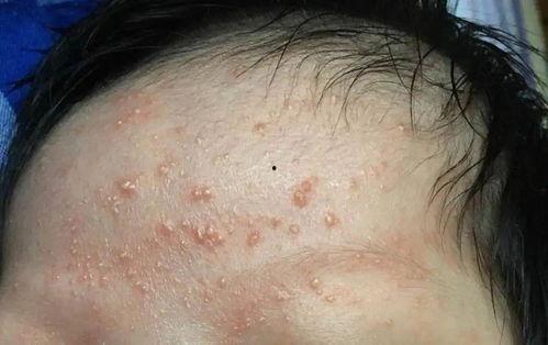 粉刺长什么样图片,揭秘常见皮肤瑕疵的真相