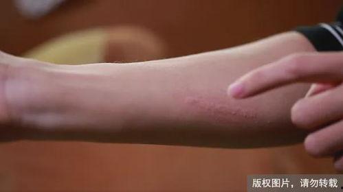 手腕过敏图片,手腕过敏症状解析与应对策略